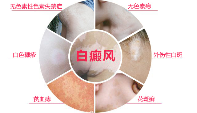 如何根据白斑诊断白癜风呢