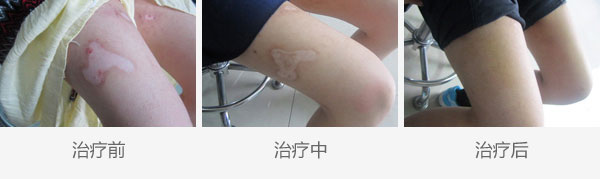 雾霾天气白癜风患者要注意什么