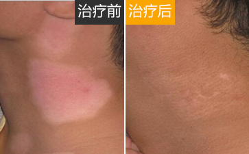 南通治疗白癜风去哪好，白癜风会复发吗