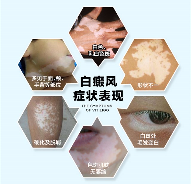 中年男性手臂皮肤有块发白是白殿疯的症状吗