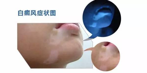 白癜风的日常预防与护理