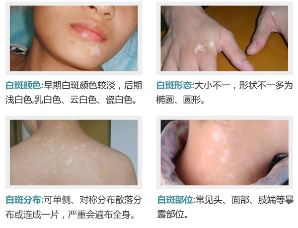 早期白癜风怎么进行控制