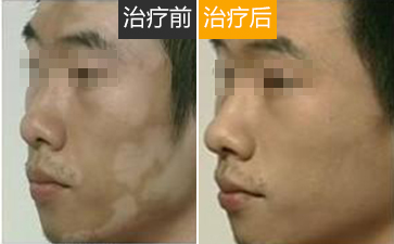 面部白癜风患者怎么治疗才会康复