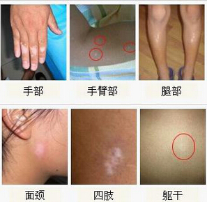 如何在洗澡时避免加重腿部白癜风