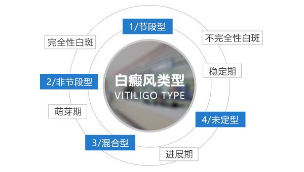 节段型白癜风治疗难度大吗