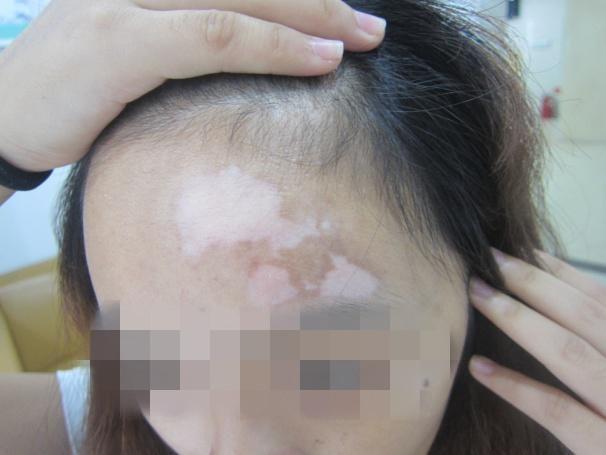 女孩子面部得了白癜风后应该怎么护理呢?