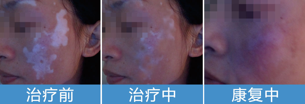白癜风治好之后怎么会出现复发呢?