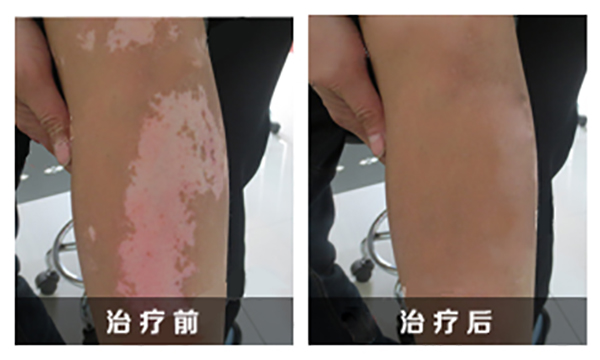 腿部白癜风怎么治才能好