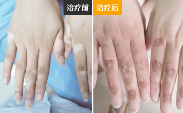 白癜风好转的过程是什么样的